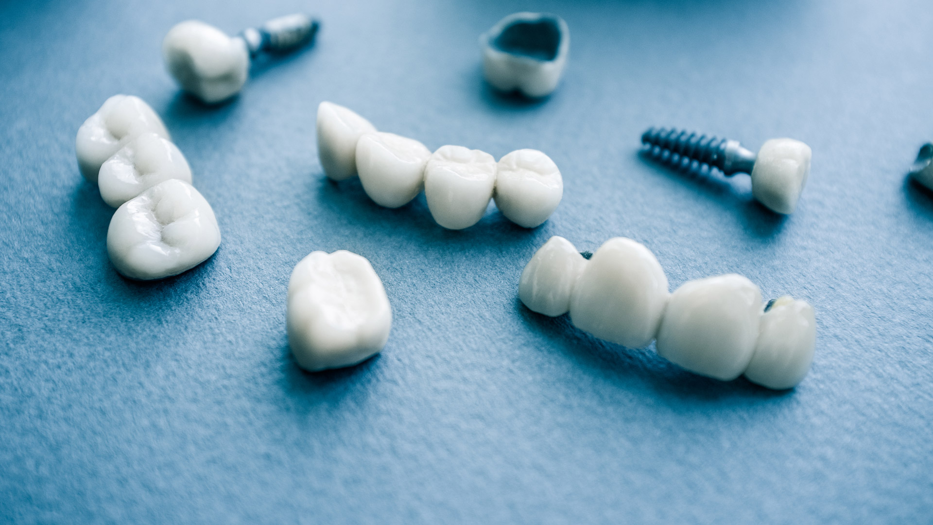 Kronen auf Implantat