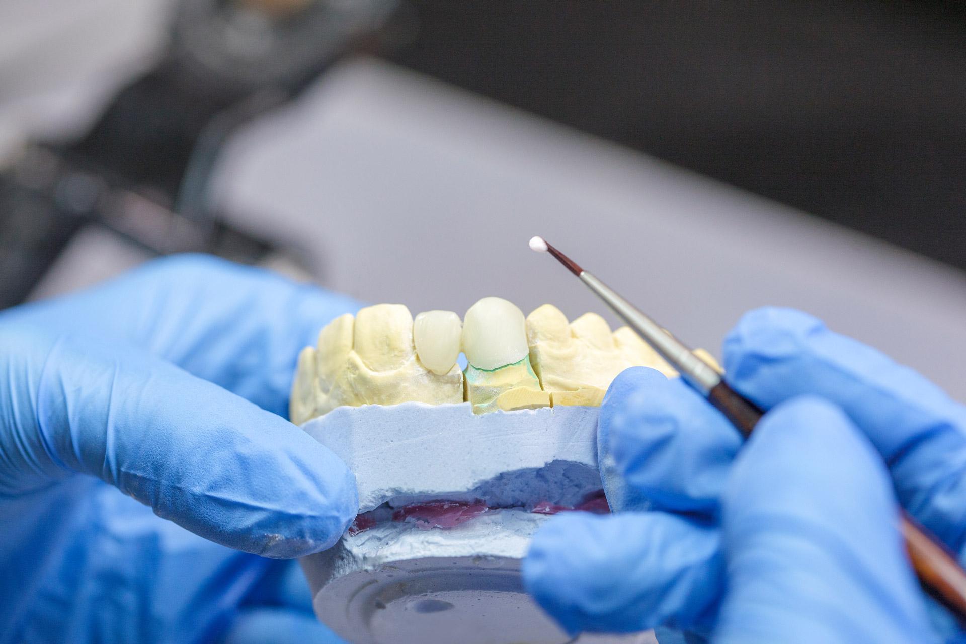 Veneers